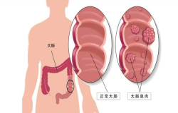 腸息肉會癌變嗎？腸鏡檢查出腸息肉千萬別大意！