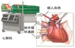 心外科團(tuán)隊(duì)中，體外循環(huán)那些事
