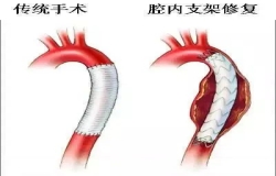 《問心》熱播！全網(wǎng)熱議的主動(dòng)脈夾層，您了解嗎？