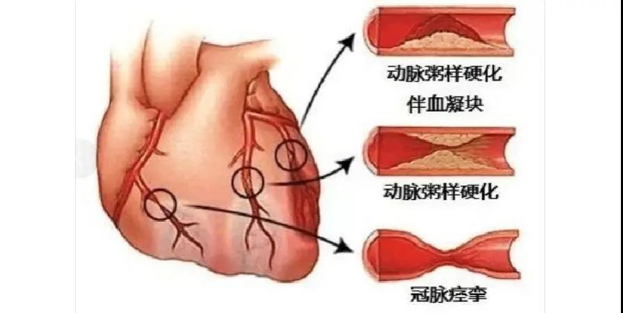 冠心病患者注意了，專業醫生為您盤點那些堅決不能停的藥！